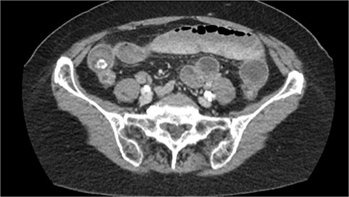 CT scan demonstrating gallstones in the small bowel.