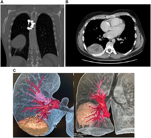 (A) CT, mass is seen in the posterior mediastinum attached to the right lung lobe. (B) CT, spongiform pattern is identified within the mass in the thorax. (C) 3D reconstruction of the CT scan, the mass can be identified in close contact with the lung.