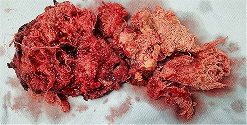 Completely excised mass formed by several gauzes without radiopaque markers.