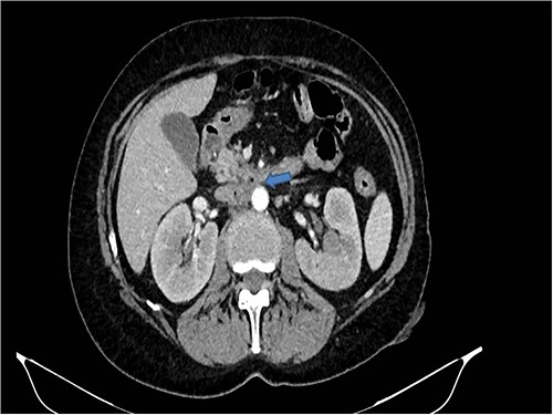 CT scan showed the presence of strong adherence between the IVC at the origin of the left renal vein and the third duodenal portion.