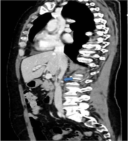 In coronal view the arrow points the air inside the vena cava and thrombotic-like hypodense material.