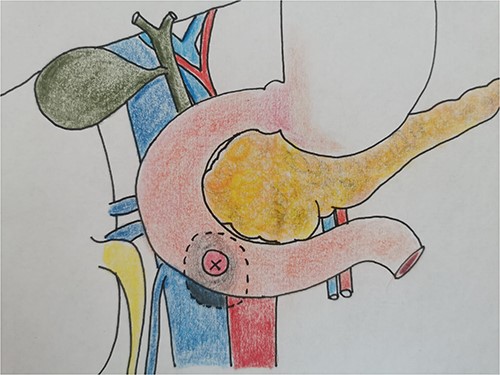 The intraoperative finding confirms the location DCF at the third duodenal portion.
