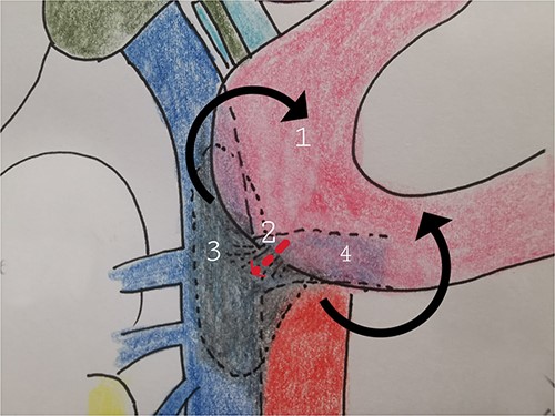 The complete kocherization of the duodenum (1) allowed to better identify the site of the fistula (2) and of the caval thrombus (3) allowing an adequate control of the left renal vein (4).