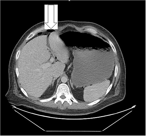 Free peritoneal air is likely related to recent LC.