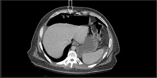 Large amount of free intraperitoneal air is present.