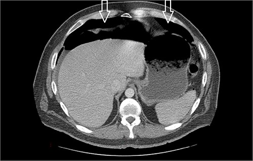 Amount of pneumoperitoneum increased compared with previous CTs.