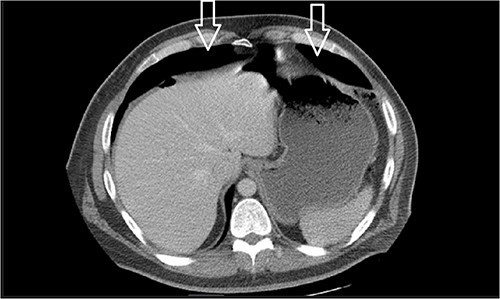 Similar appearance of moderate volume pneumoperitoneum compared with last CT.