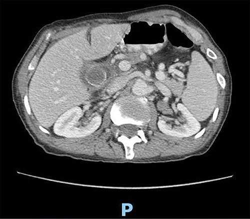 Enhanced CT scan of the abdomen confirming the presence of a 2.5-cm gallstone.
