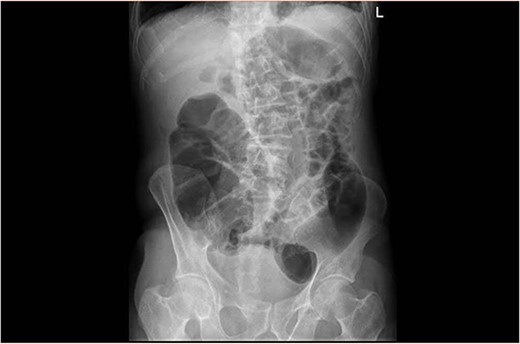 Plain abdominal X ray showing a dilated large bowel loop.