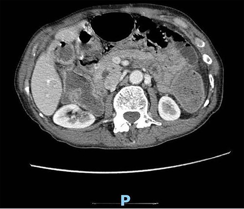 Enhanced CT scan of the abdomen showing evidence of partial large bowel with pneumobilia, gallbladder seen with interrupted wall and suspected fistula with the hepatic flexure (axial view).