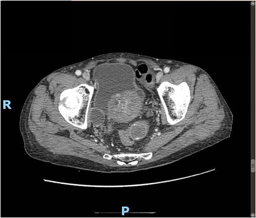 Enhanced CT scan of the abdomen showing a gallbladder stone impacted at the sigmoid colon, with a significantly enlarged prostate causing narrowing of the rectosigmoid junction (axial view).