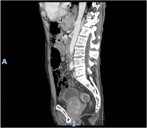 Enhanced CT scan of the abdomen showing a gallbladder stone impacted at the sigmoid colon, with a significantly enlarged prostate causing narrowing of the rectosigmoid junction (sagittal view).