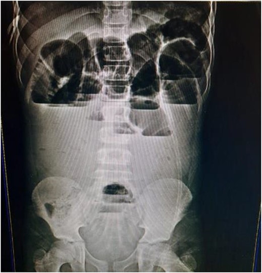 The abdominal X-ray showed multiple air-fluid levels.