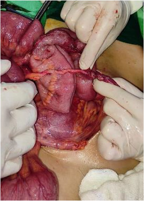 The fibrous band connected to the umbilicus, where the small intestines were wrapped around the band.