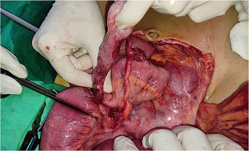 The (MD) and fibrous band; as they were removed.