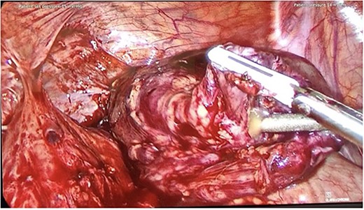 Intraoperative photo from Patient B, showing conduit perforation with purulent exudate.