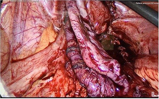 Intraoperative photo from Patient B, showing a segment of ischemic sigmoid conduit.