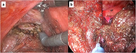 Intraoperative findings in hybrid surgery. (a) Robot-assisted approach. (b) Trans-perineal approach. The two photographs show the dissection of the posterior wall of the vagina.