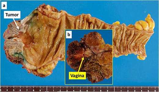 Macroscopic photograph of the specimen. (a) The tumour indicated by the white arrow was a Type 3 tumour measuring 25 × 25 mm. (b) The photograph in the yellow window shows the dissection surface. The yellow arrow indicates the resected vagina.