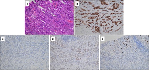 (a) Histopathological findings revealed an adenocarcinoma based on haematoxylin and eosin staining (×10). (b-e) Immunohistochemically, the tumour was positive for cytokeratin 7 (×10) (b), negative for cytokeratin 20 (×10) (c), positive for caudal-type homeobox-2 (×10) (d) and focally positive for mucin 5 subtype AC (×10) (e).
