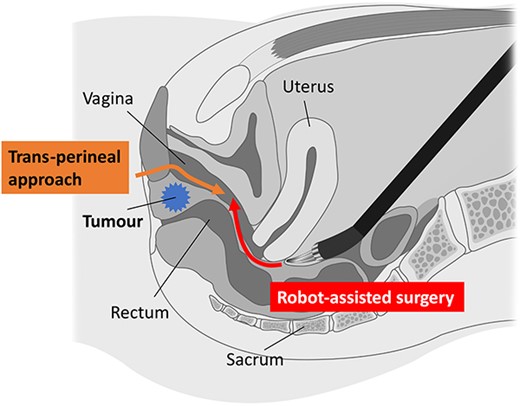 Schema of hybrid surgery. In robot-assisted surgery, the cutting of the vaginal vault can be performed more easily and accurately owing to multi-joint manipulation. The simultaneous perineal approach confirmed the surgical margin of the tumour under magnification.