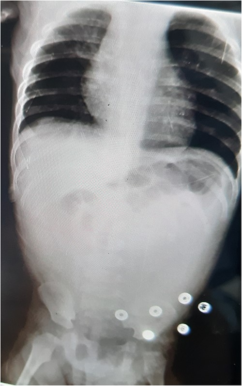 AXR: no gas liquid levels—no free gas in the abdomen—dilation of intestinal loops and lack of gas in the abdomen and pelvis.