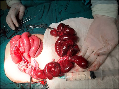 Image during resection showing giant MD and necrotic small intestine.