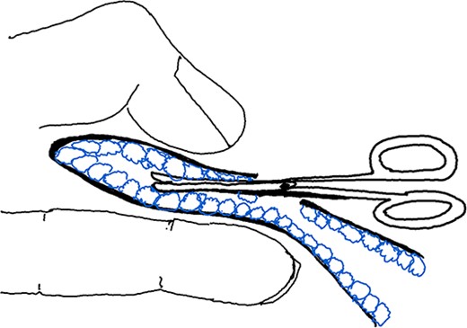 Illustration of Maneuver 1. Small, blunt scissors inserted into the skin flap opening lifted by the assisting hand. Scissors used to cut apocrine glands between flaps.