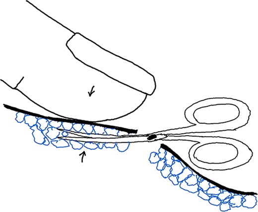 Illustration of Maneuver 2. Skin flap pressed down with assisting hand’s fingers. Blunt scissors inserted, supporting flap and cutting glands gently by opening and closing.