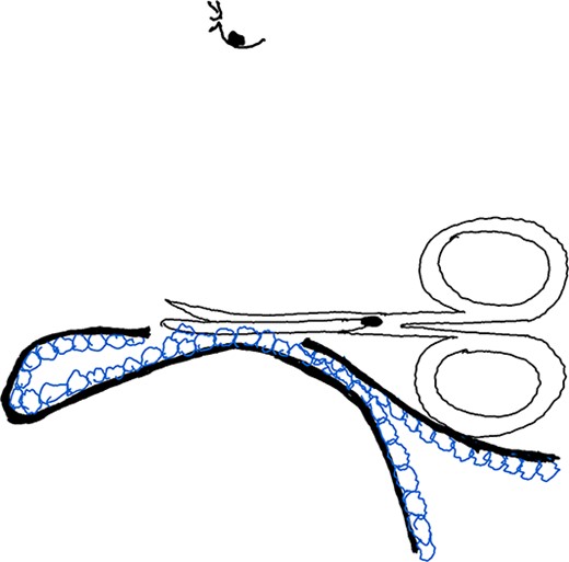 Illustration of Maneuver 3. Skin flap pulled up by the assisting hand, creating a small space to expose and remove apocrine glands under visual guidance using a pinch and turn over technique.