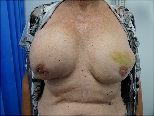 Patient at presentation with an enlarged right breast.