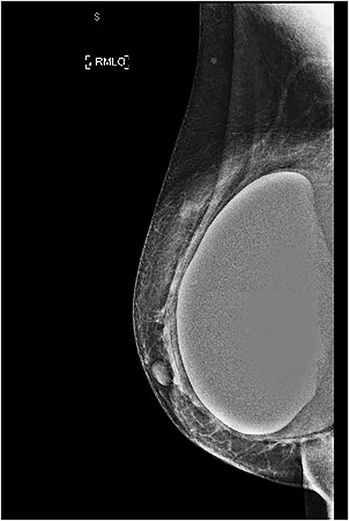 MMG of the right breast in MLO view showing a lesion in the upper breast.