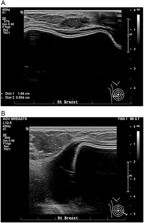 A: USS of the right breast showing a mass at the 9 o’clock position. B: USS of the right breast showing a peri-implant effusion.