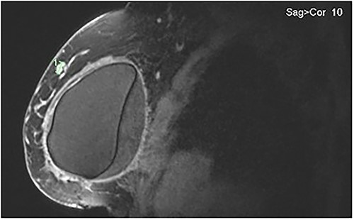 MRI of the right breast demonstrating peri-implant effusion and the confirmed IDC in the upper outer quadrant at the 9 o’clock position.