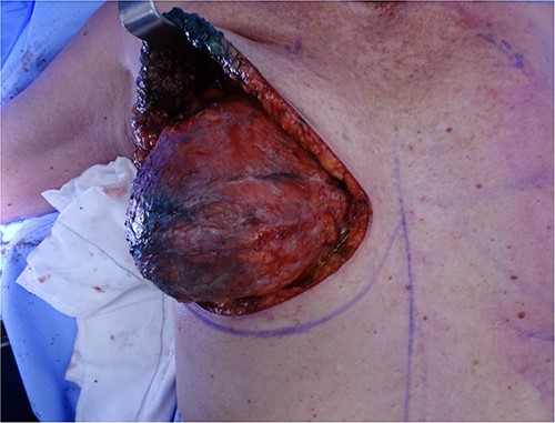 Intraoperative photo of the right sided peri-implant effusion.