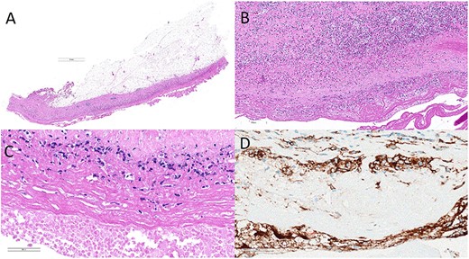Histology of right breast capsule (A–C) showing an inflammatory infiltrate with aggregates of atypical lymphoid cells with strong CD30 positivity on immunohistochemistry (D).