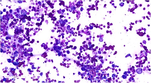 Cytology of intraoperative peri-implant fluid demonstrating atypical lymphoid cells.