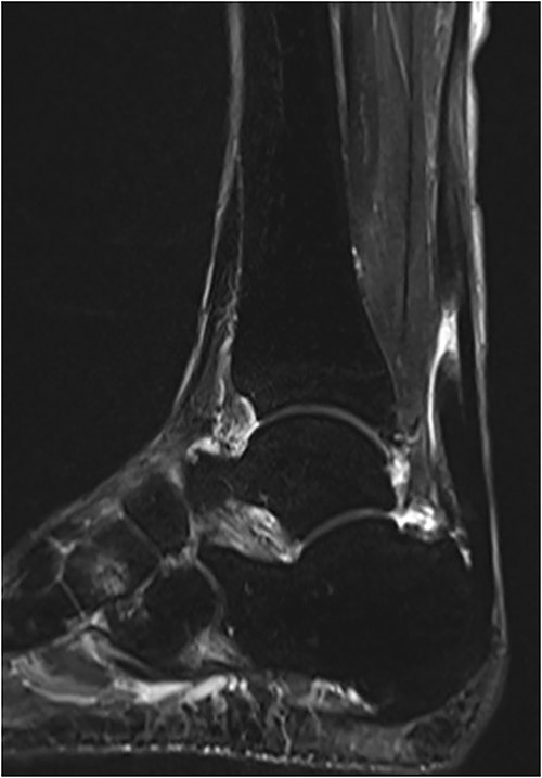 MRI revealed ATR with a gap between tendon ends.
