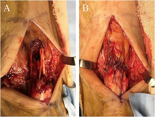 (A) In the rupture site, scar tissues and degenerative tendon were seen. (B) After these tissues were adequately debrided, the ruptured tendon was directly repaired using the modified SLLS technique.