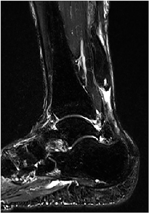 MRI revealed ATR with a gap between tendon ends.