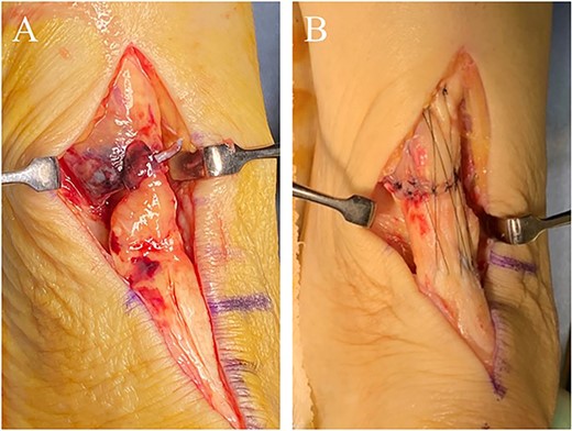 (A) In the rupture site, scar tissues and degenerative tendon were confirmed. (B) The operation was performed as same as Case 1.