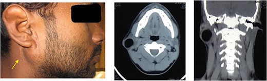Clinical picture of patient showing swelling in the right parotid region with visible scar and axial and coronal section of CT imaging showing well-defined cystic lesions in the right parotid gland.