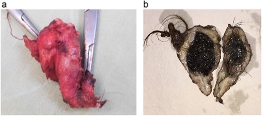 (a) Excised specimen (b) cut section showing the cyst filled with hair and pultaceous material.