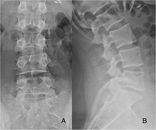 Preoperative PA and lateral films demonstrate decreased disc height at L5-S1.
