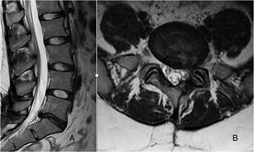 T2-weighted MRI sagittal and axial cuts demonstrate recurrent disc herniation with left-sided foraminal stenosis and degenerative changes at L5-S1.