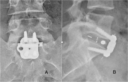 Post-operative posterior-anterior (A) and lateral (B) films demonstrate ALIF cage and plate placement.