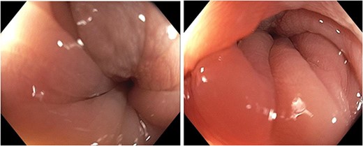 Preoperative colonoscopy: 90% stenosis conditioned to sigmoid colon.