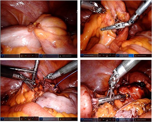Transoperative findings.