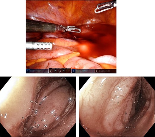 Transoperative colonoscopy.