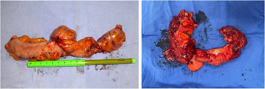 Surgical piece.